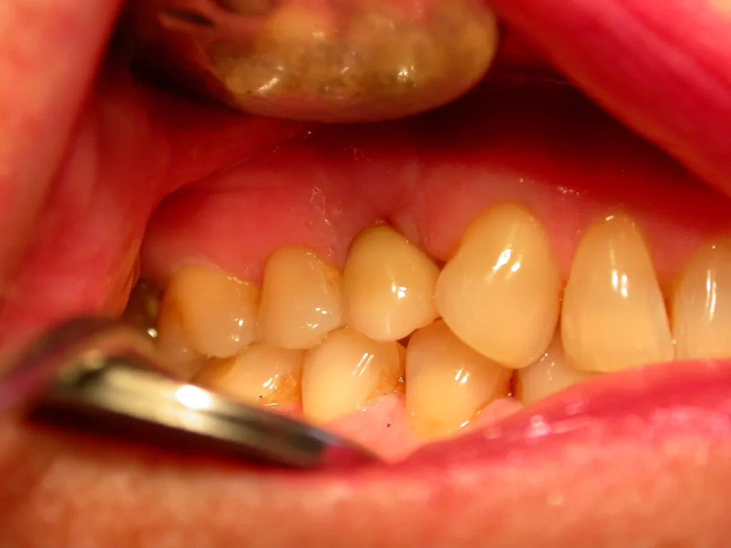 Ergebnis nach Befestigung der Krone auf Implantat 13 bei Dr. Peter, Arnstorf