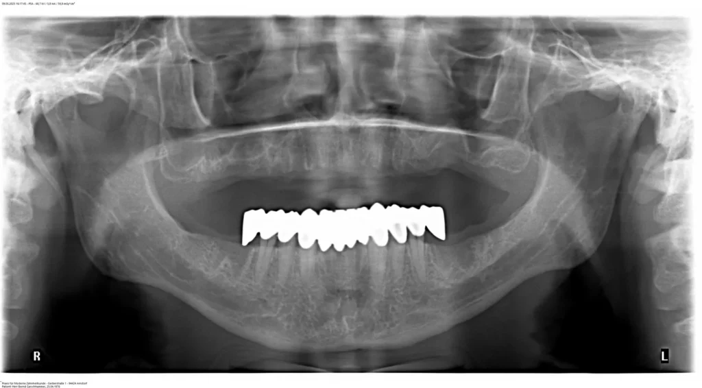 Vor Implantologie mit Gerüstimplantaten bei Knochenschwund: Dr. Peter, 94424 Arnstorf