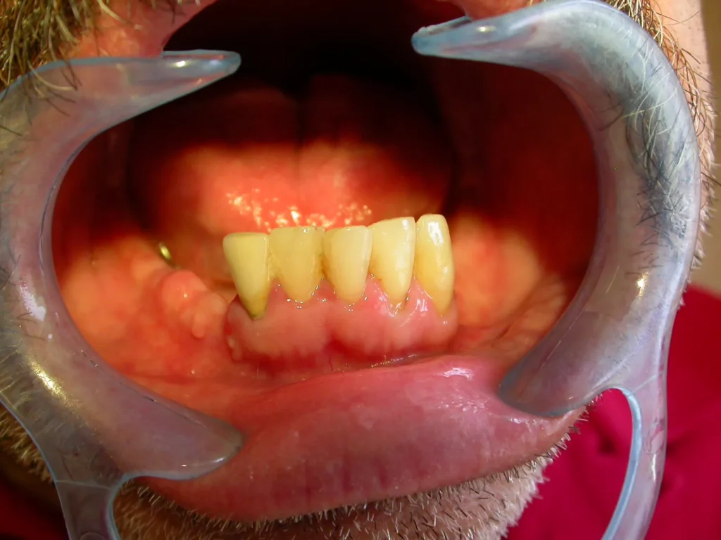Vor Implantation für herausnehmbaren Zahnersatz bei Dr. Peter, 94424 Arnstorf