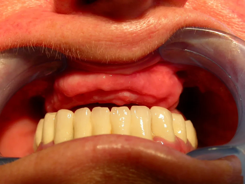 Implantologie: Zahnloser Oberkiefer vor Implantatversorgung bei Dr. Peter