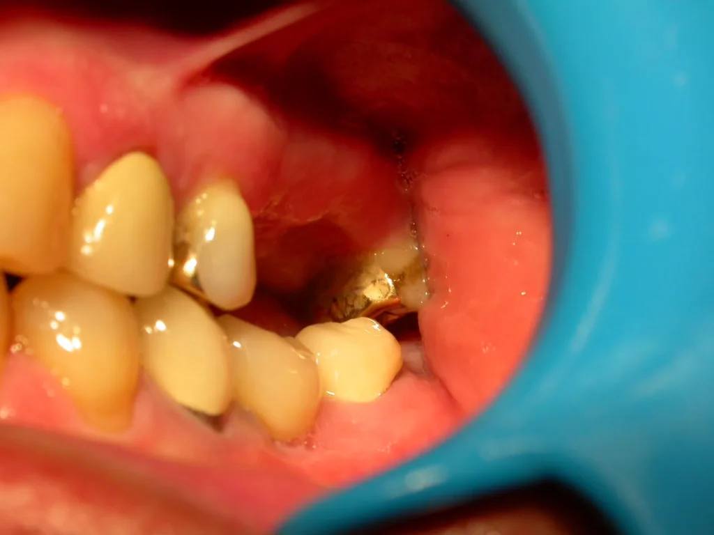 Fehlende Backenzähne vor Keramikimplantat-Behandlung bei Dr. Peter, 94424 Arnstorf