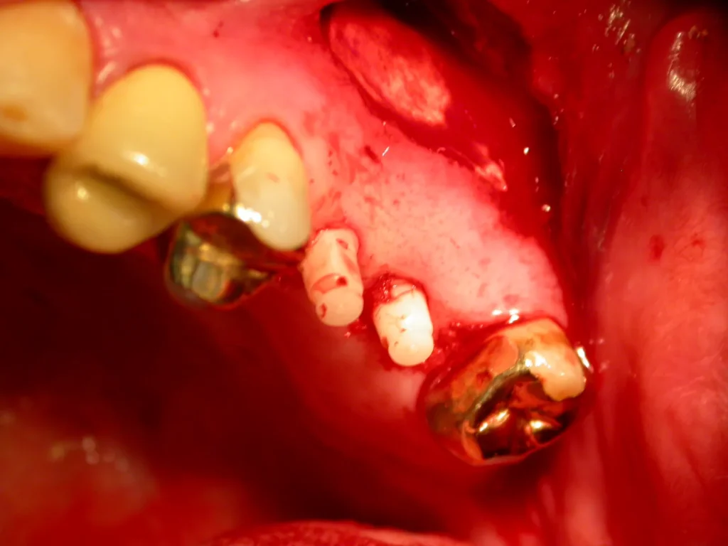 OP mit Keramikimplantaten und Sinuslift bei Dr. Peter, 94424 Arnstorf