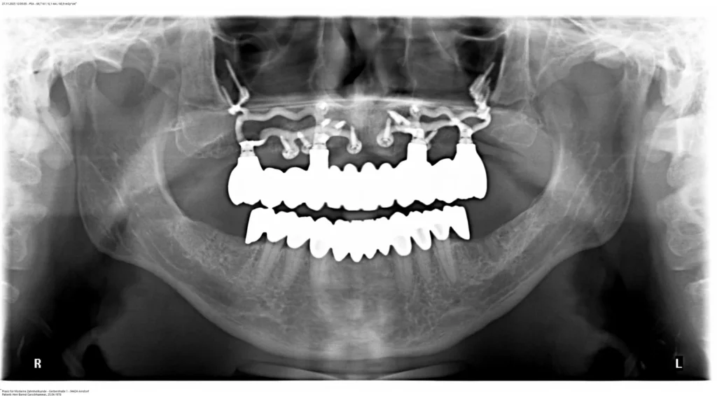 Gerüstimplantate (No Bone Implantate) im Oberkiefer - Dr. Peter, 94424 Arnstorf