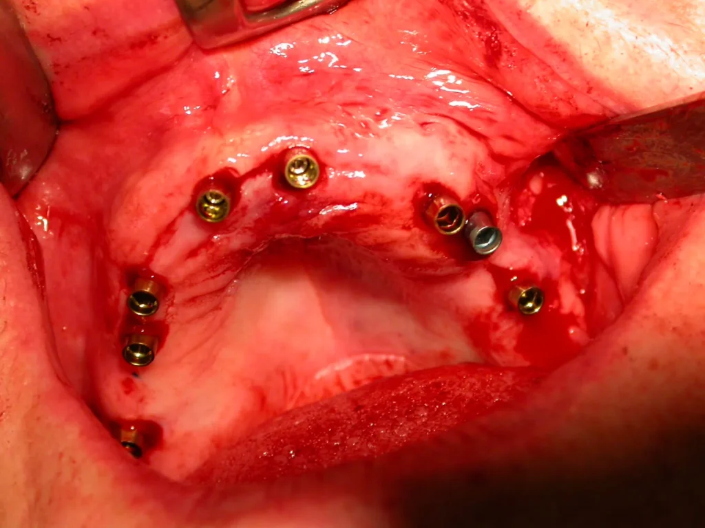 Schonende Implantation bei Dr. Peter, Arnstorf