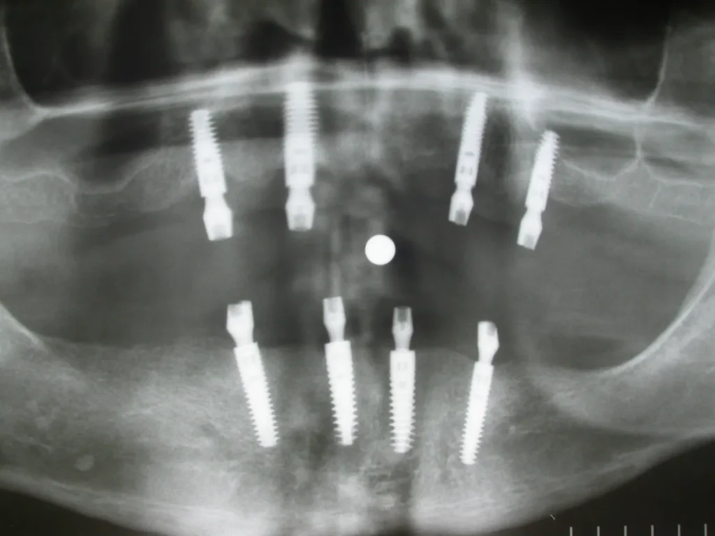 Röntgen mit je 4 Implantaten im Ober- & Unterkiefer von Dr. Peter in 94424 Arnstorf