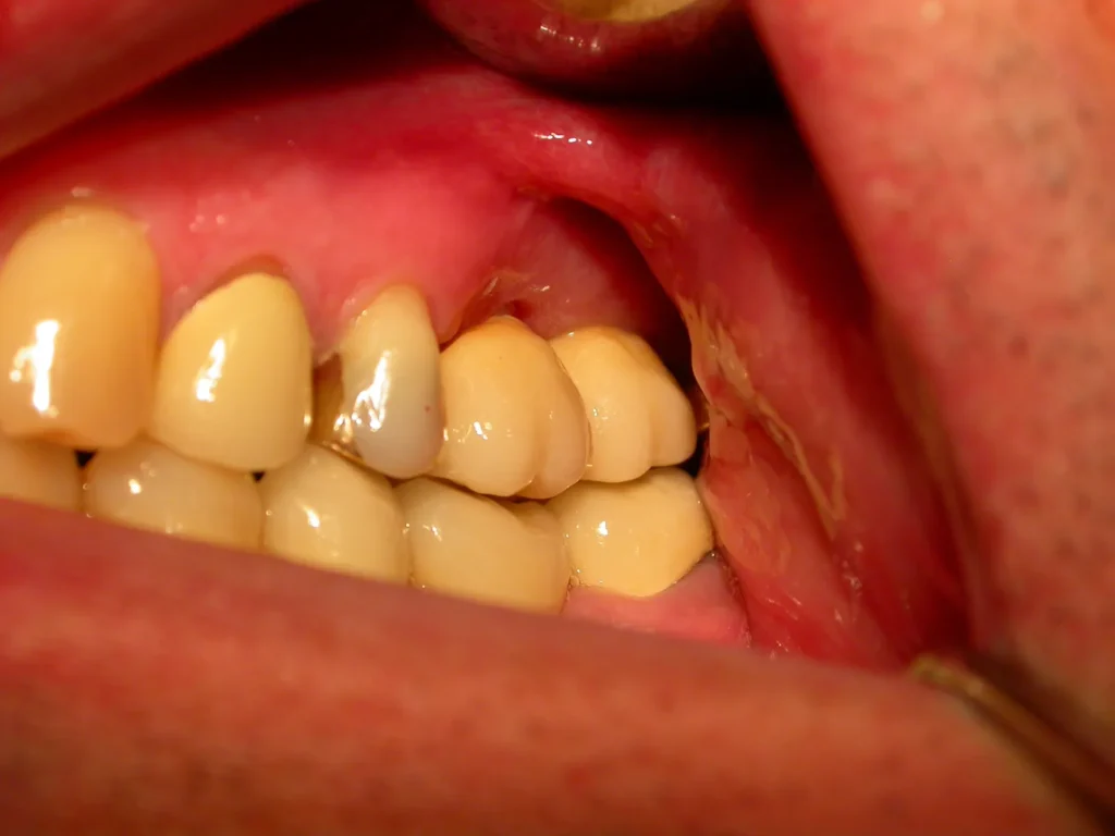 Keramikkronen auf Zirkonimplantaten: Dr. Peter, 94424 Arnstorf