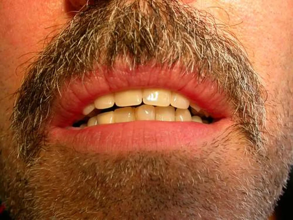 Herausnehmbare Prothesen im Ober- & Unterkiefer - Dr. Peter, Arnstorf