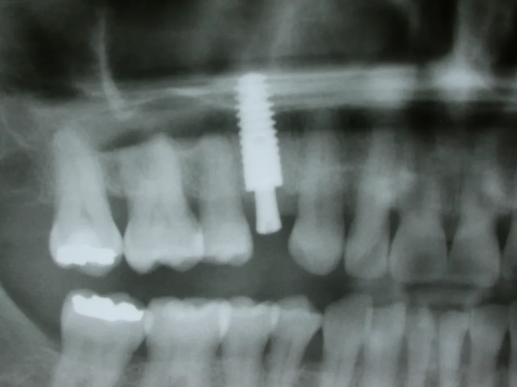 Röntgen nach Implantatin regio 13 - Dr. Peter, 94424 Arnstorf
