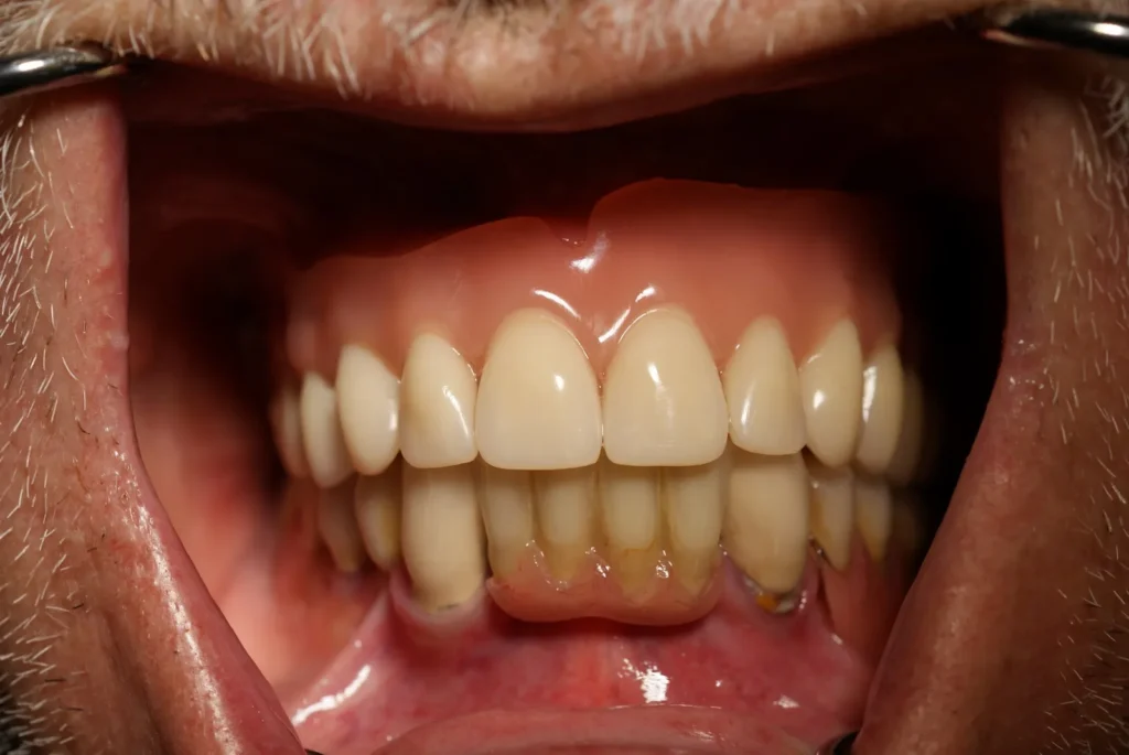 Herausnehmbare festsitzende Prothese auf 4 Implantaten - Dr. Peter, 94424 Arnstorf