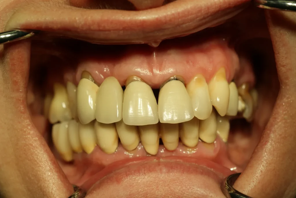 Schlechte Oberkieferzähne vor Sanierung mit Keramikimplantaten bei Dr. Peter, Arnstorf