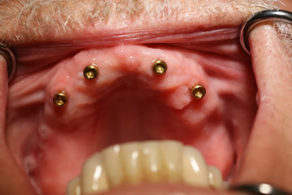 4 Implantate im Oberkiefer für Locator-Prothese - Dr. Peter, 94424 Arnstorf