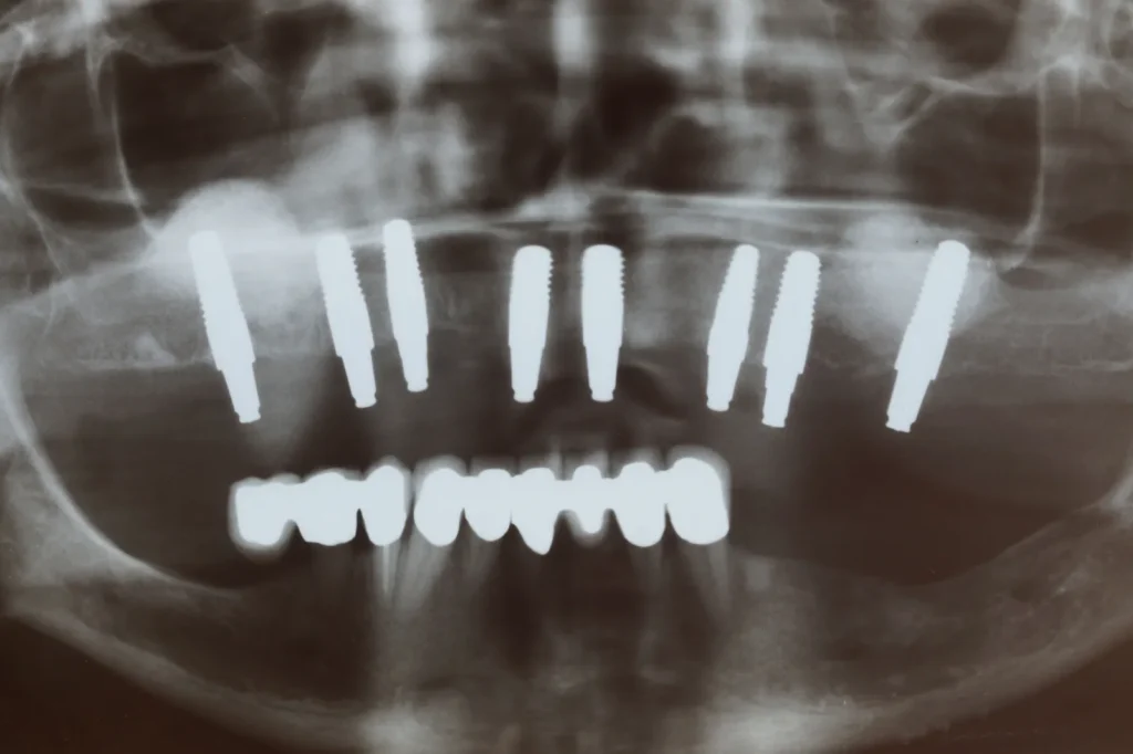 Sofortimplantation mit Knochenaufbau und Keramikimplantaten: Dr. Peter, Arnstorf