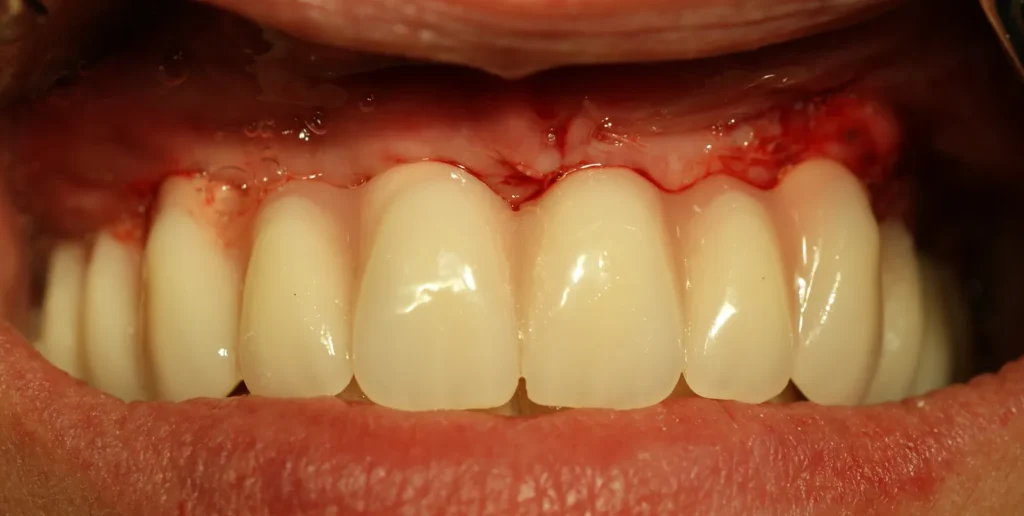 Sofortversorgung der Keramikimplantate mit provisorischer Brücke: Dr. Peter, Arnstorf