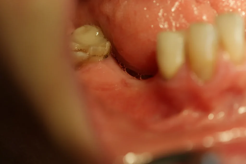 Zahnlücke im Unterkiefer vor Behandlung mit Keramikimplantaten bei Dr. Peter, Arnstorf