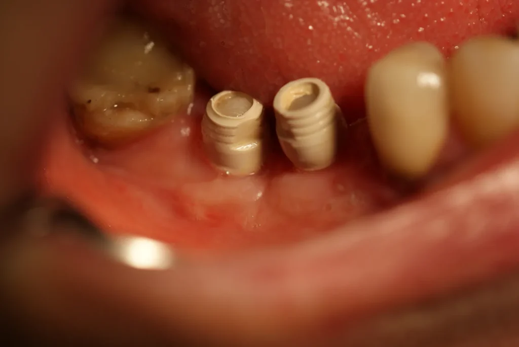 Keramikimplantate mit Käppchen für provisorische Kronen: Dr. Peter, Arnstorf