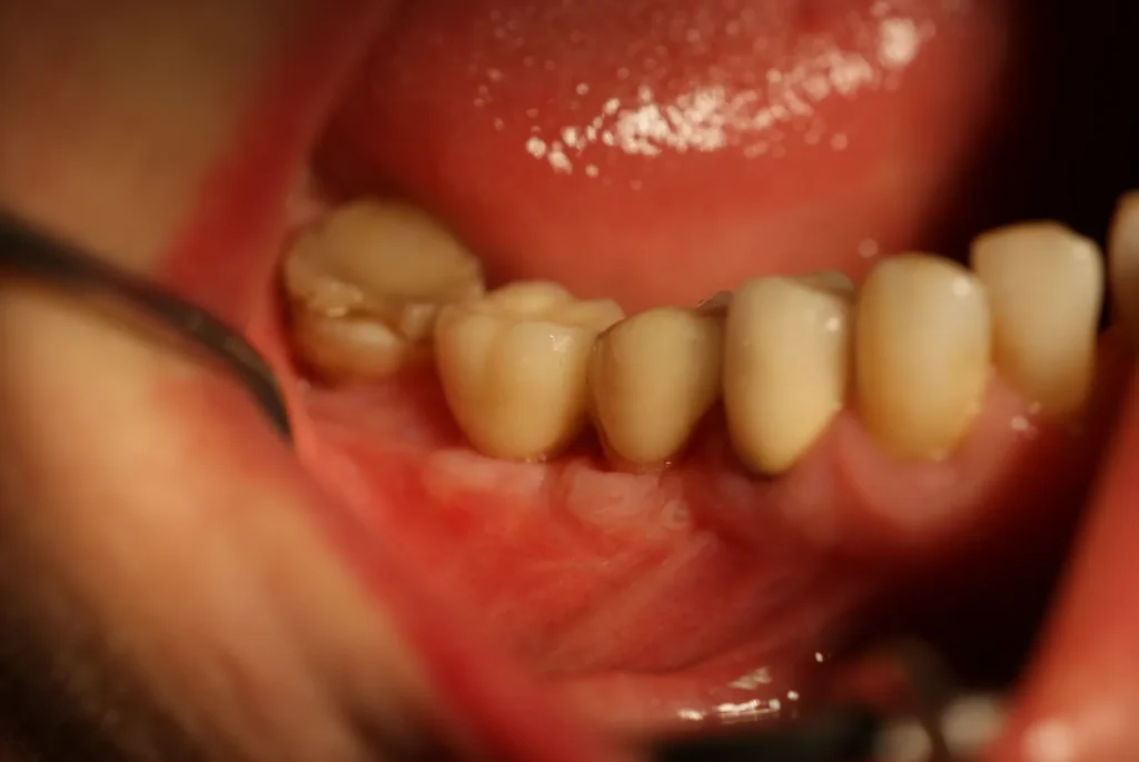 Endgültige Kronen auf Keramikimplantaten - Dr. Peter, 94424 Arnstorf