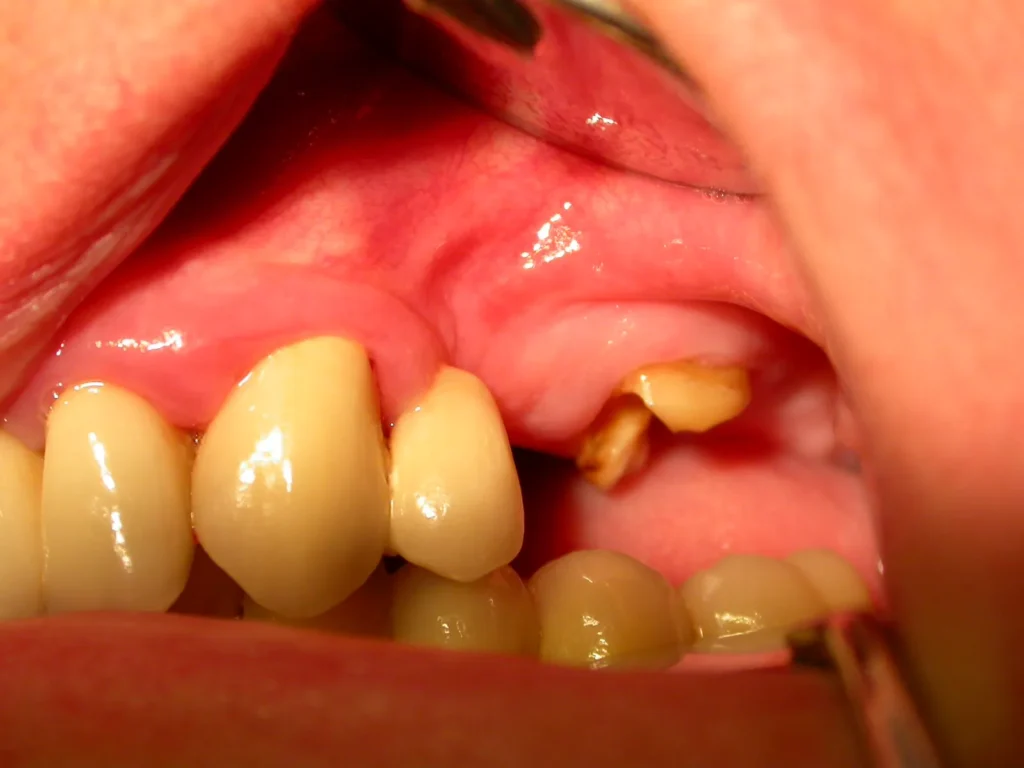 Oberkiefer links vor Behandlung mit Keramikimplantaten bei Dr. Peter, Arnstorf