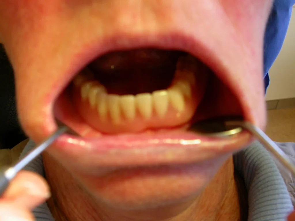 Schlechter Prothesenhalt im Unterkiefer ohne Implantate - Dr. Peter, Arnstorf