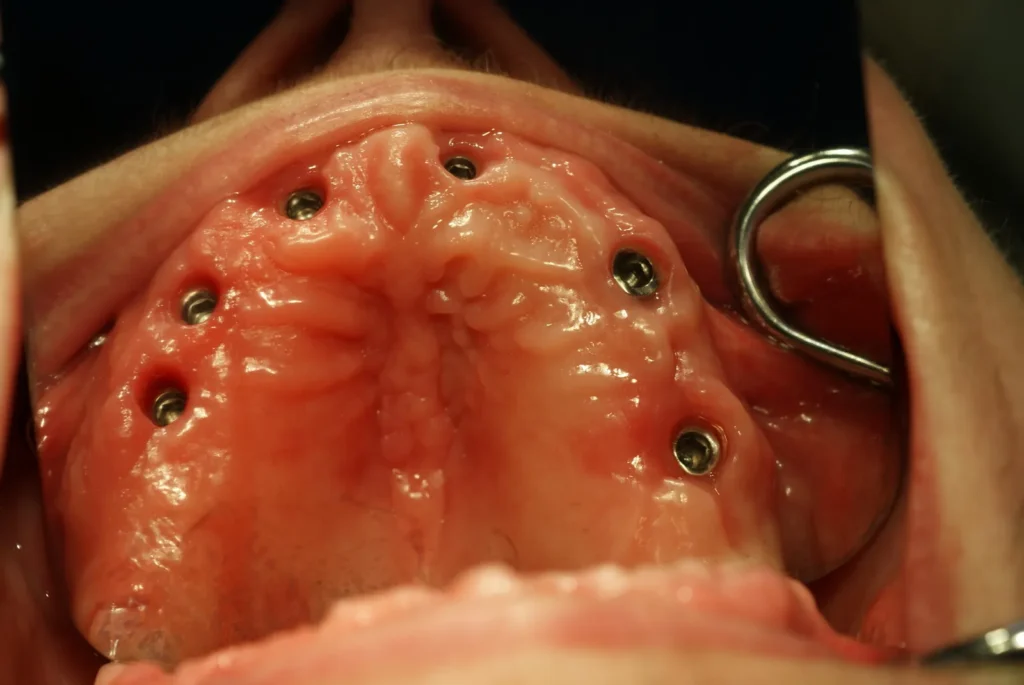 Oberkiefer-Implantate vor Zahnersatz: Dr. Peter, Arnstorf