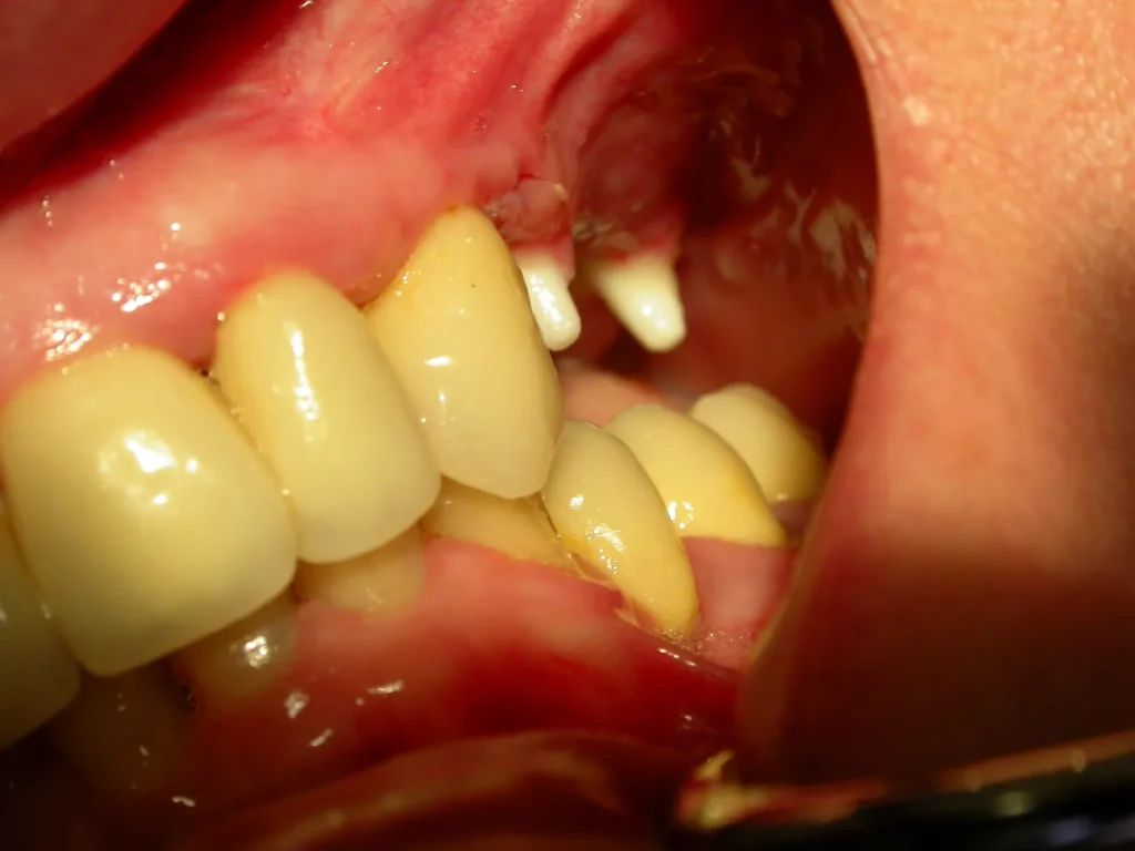 2 Keramikimplantate mit Knochenaufbau: Dr. Peter, 94424 Arnstorf