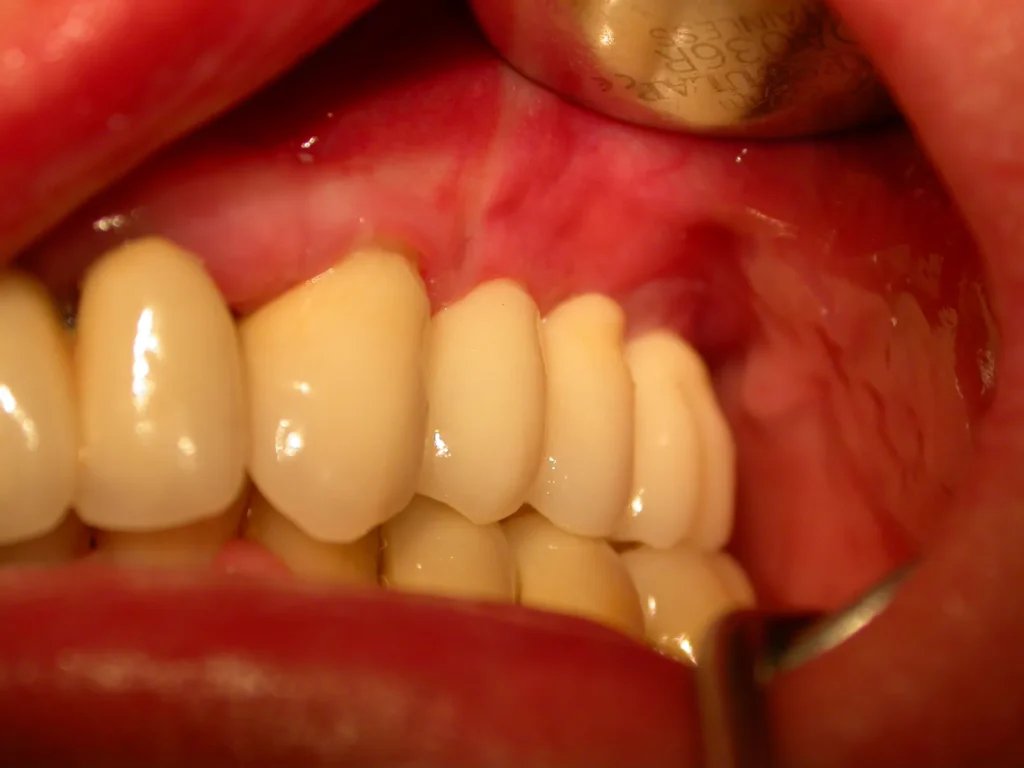 Ästhetisch-funktionelle Überkronung der Keramikimplantate: Dr. Peter, Arnstorf