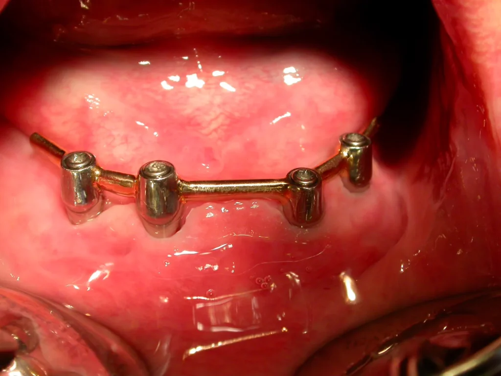 Steg auf 4 Implantaten - Implantologie Dr. B. Peter, 94424 Arnstorf