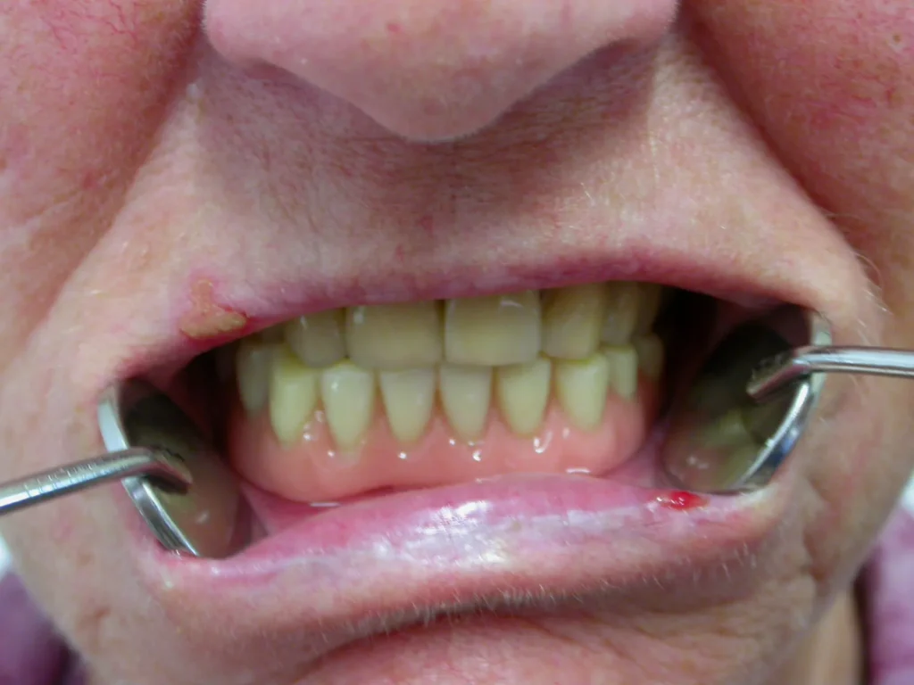 Festsitzende Unterkiefer-Prothese auf 4 Implantaten - Dr. Peter, 94424 Arnstorf
