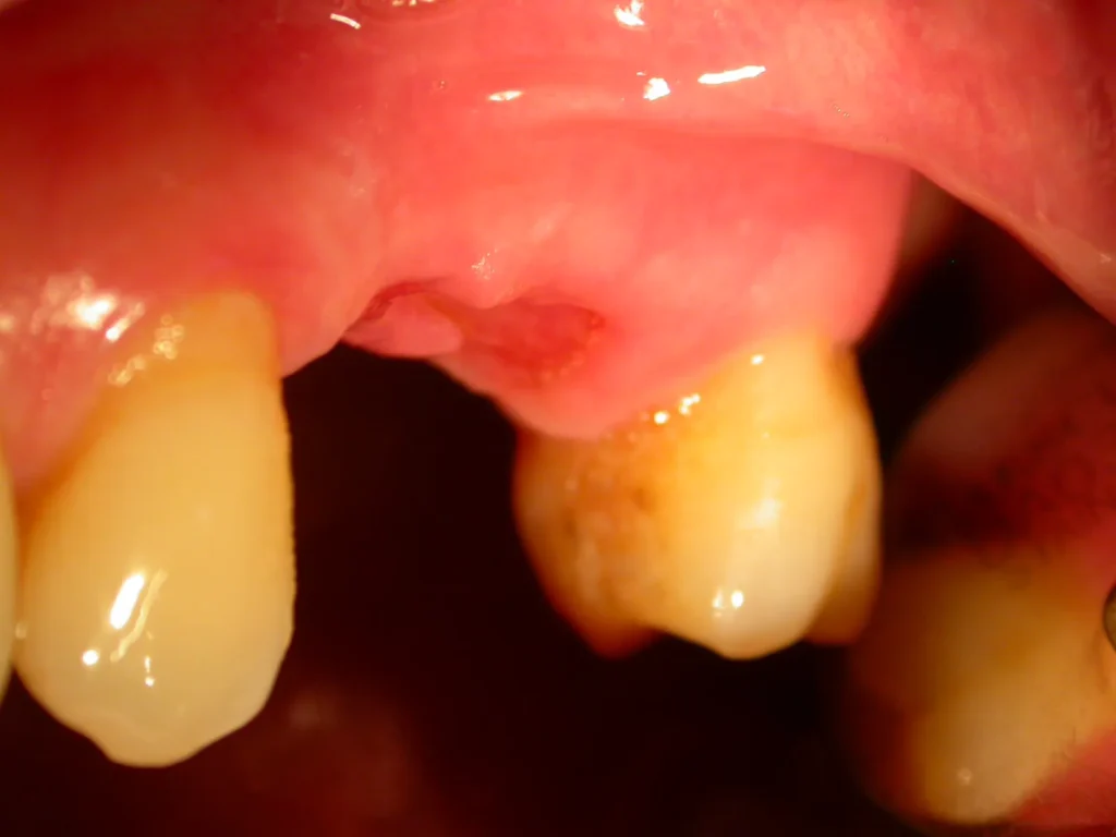 Oberkieferzahnlücke vor Implantologie mit Keramikimplantaten bei Dr. Peter, Arnstorf