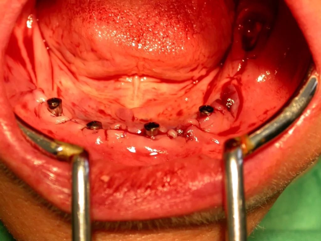 4 Implantate im Unterkiefer - Zahnimplantate Dr. B. Peter, 94424 Arnstorf