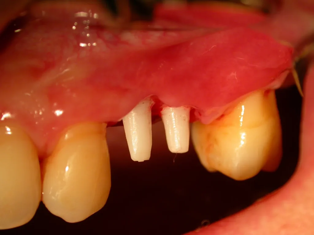 Schonend befestigte Keramikimplantate mit Knochenaufbau - Dr Peter, Arnstorf
