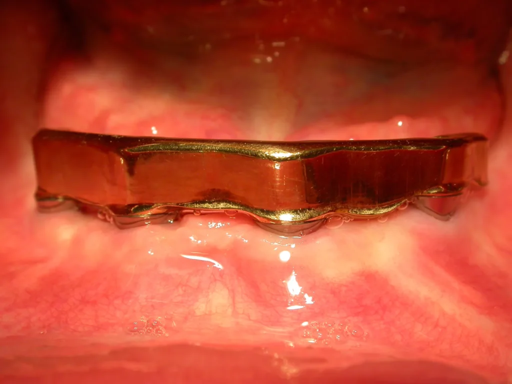 Geschiebekonstruktion für herausnehmbare Prothese auf Implantaten von Dr. Peter