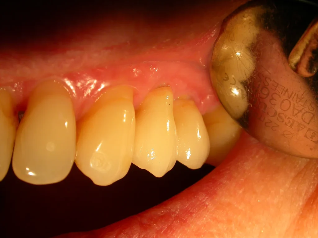 Auf Zirkonimplantaten befestigte Keramikkronen: Dr. Peter, 94424 Arnstorf