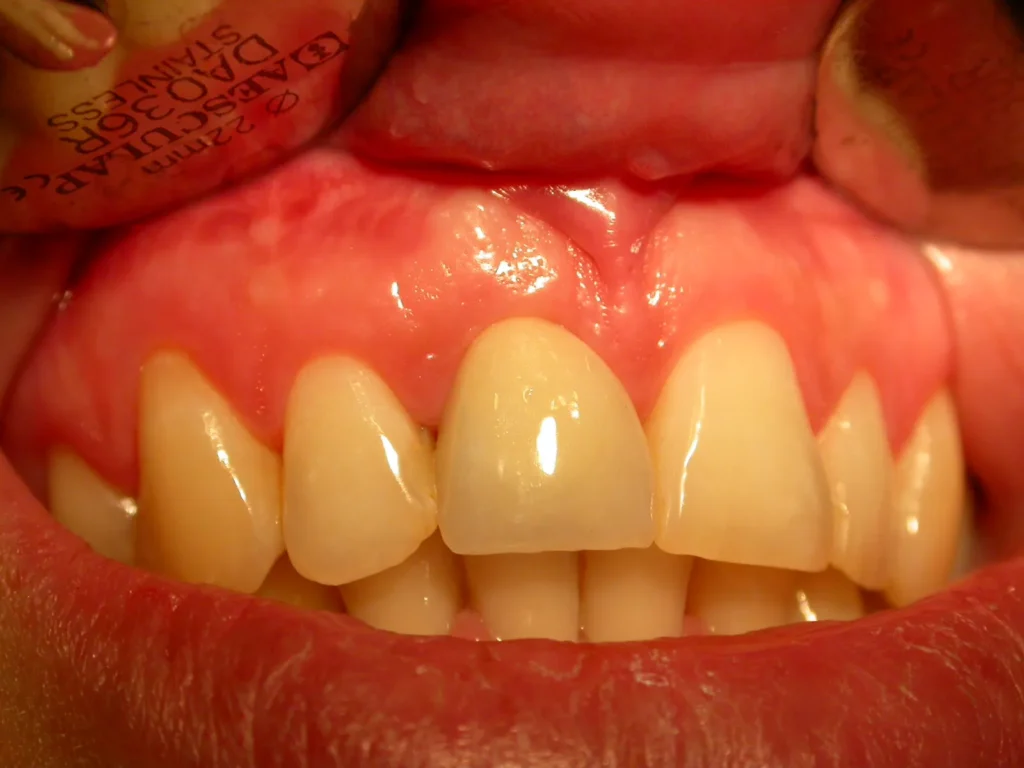 Ergebnis mit Krone auf Implantat 11: Dr. B. Peter, 94424 Arnstorf