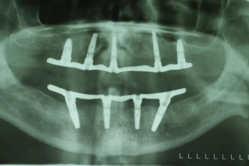 Implantate-Röntgen von Dr. Peter, 94424 Arnstorf