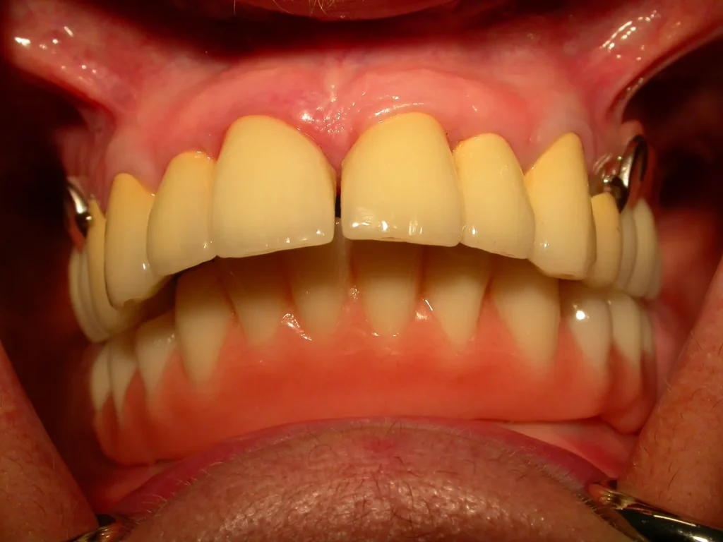 Eingegliederte Unterkiefer-Prothese mit Geschiebe auf Implantaten - Dr. Peter, Arnstorf