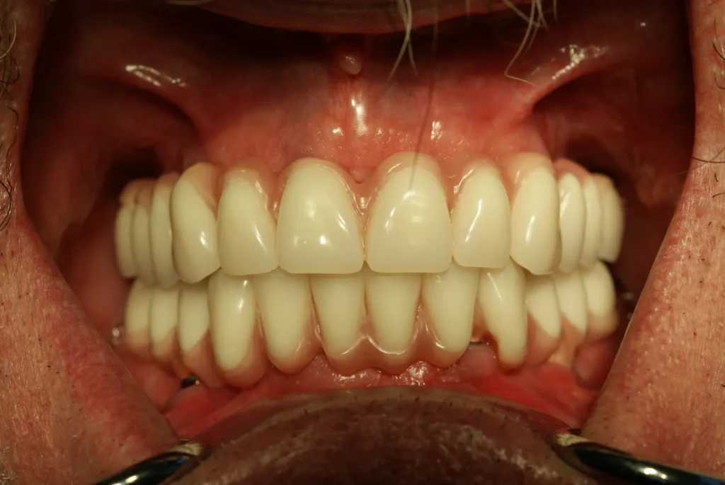 Implantat-Brücken für Zahnersatz Ober- & Unterkiefer: Dr. Peter, Arnstorf