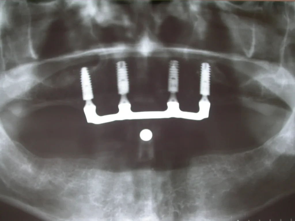 Röntgenkontrolle Implantate mit Steg von Dr. Peter, 94424 Arnstorf