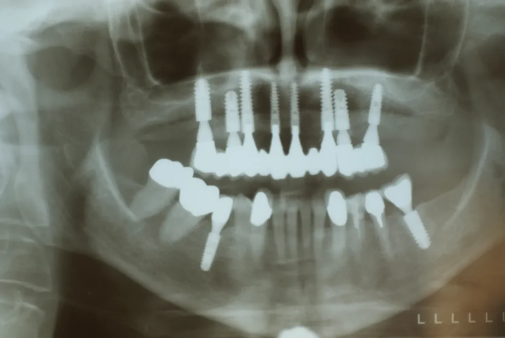 Röntgen nach Implantat-Behandlung kompletter Oberkiefer: Dr. Peter, Arnstorf