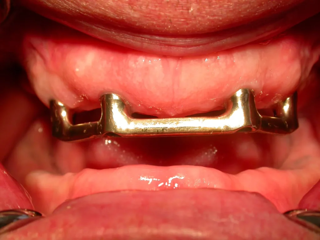 Stegkonstruktion auf 4 Implantaten für herausnehmbare Prothese - Dr. Peter, Arnstorf