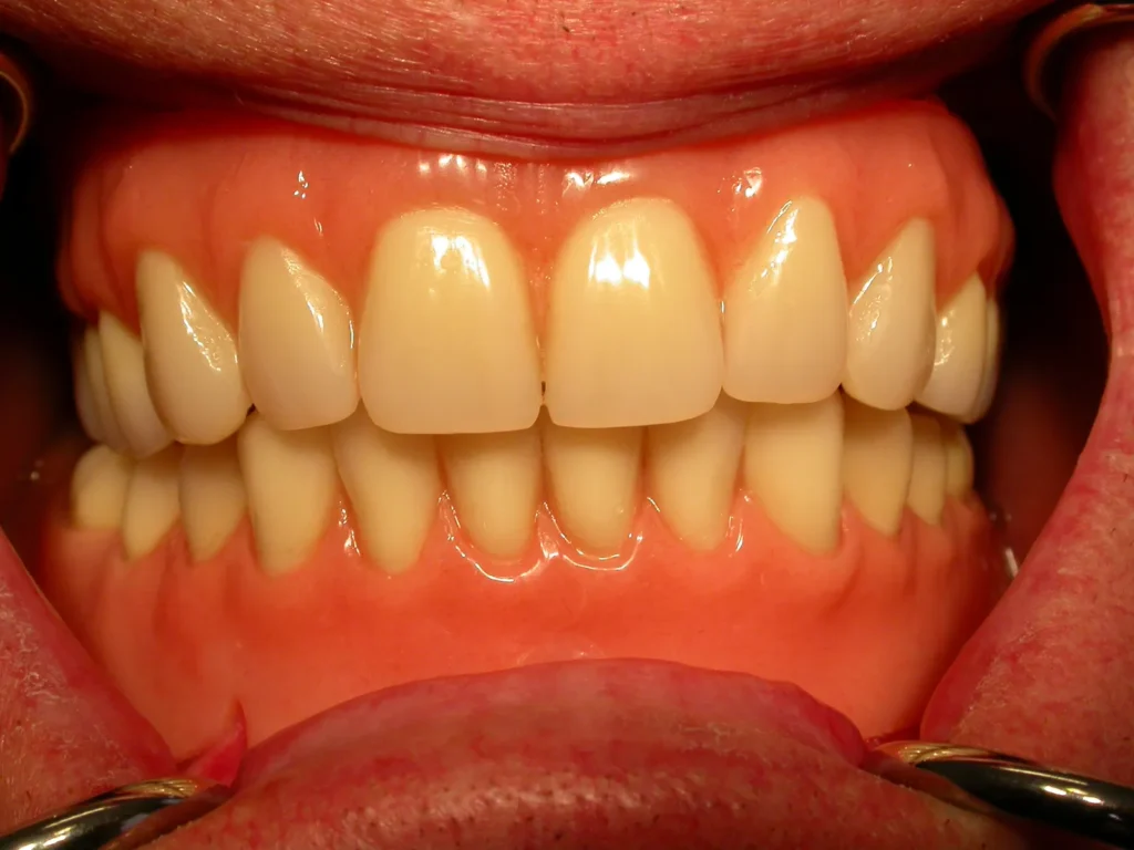 Festsitzende Prothese auf Implantat-Steg - Dr. Peter, 94424 Arnstorf