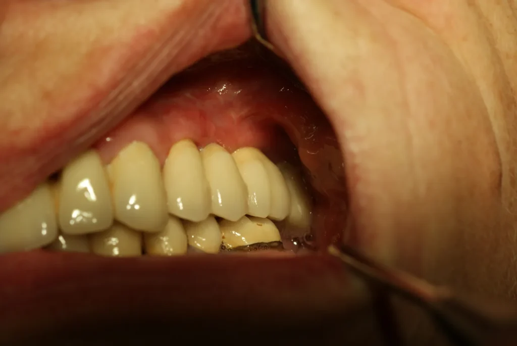 Auf Zirkonimplantaten fixierte Keramikbrücke im Oberkiefer: Dr. Peter, Arnstorf