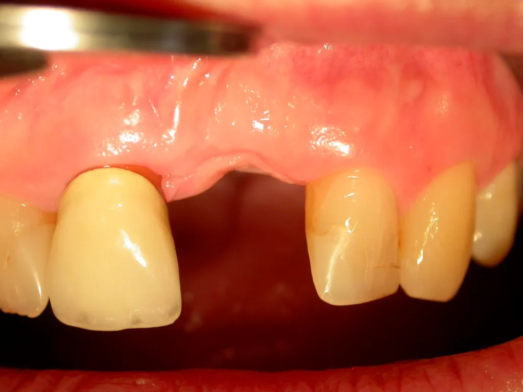 Frontzahnlücke im Oberkiefer vor Keramik-Implantation bei Dr. Peter, Arnstorf