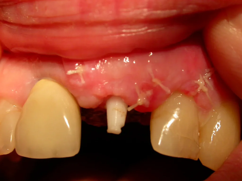 Nach Implantologie mit Keramikimplantat und Knochenaufbau: Dr. Peter, Arnstorf