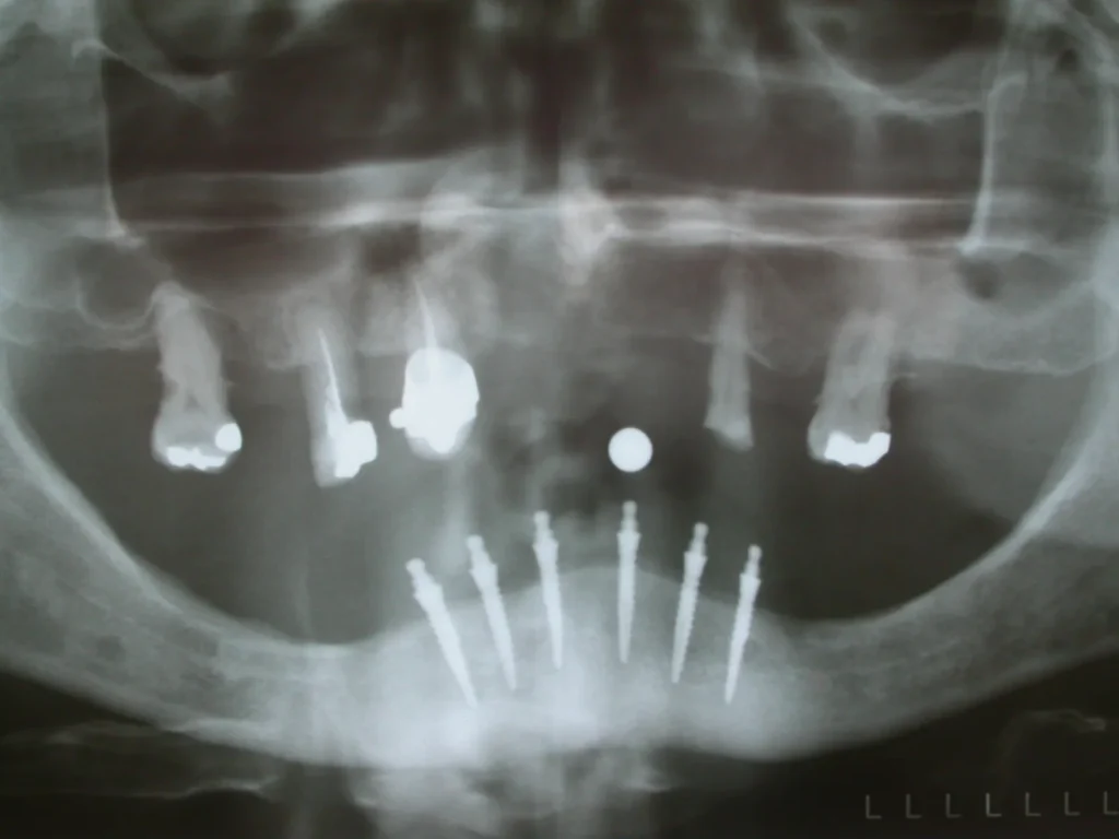 Röntgen von 6 Miniimplantaten - Dr. Peter, 94424 Arnstorf