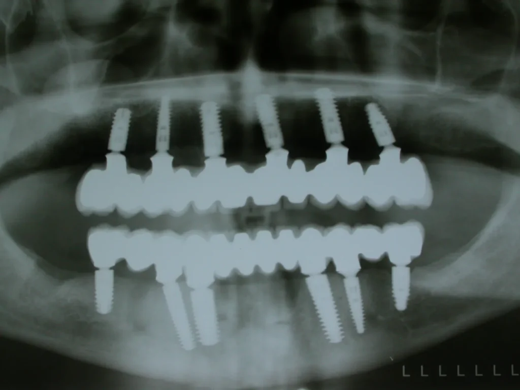 Röntgen von Ober-& Unterkiefer-Implantaten: Dr. Peter, 94424 Arnstorf