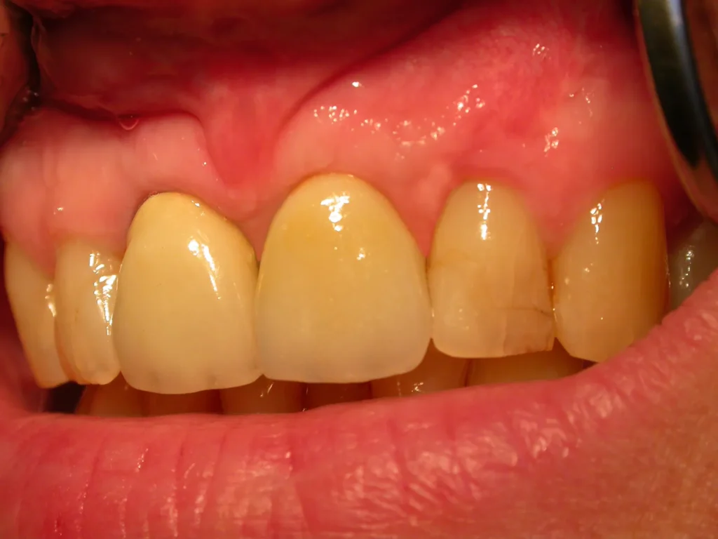 Ästhetisch-funktionell gelungene Krone auf Keramikimplantat: Dr. Peter, Arnstorf
