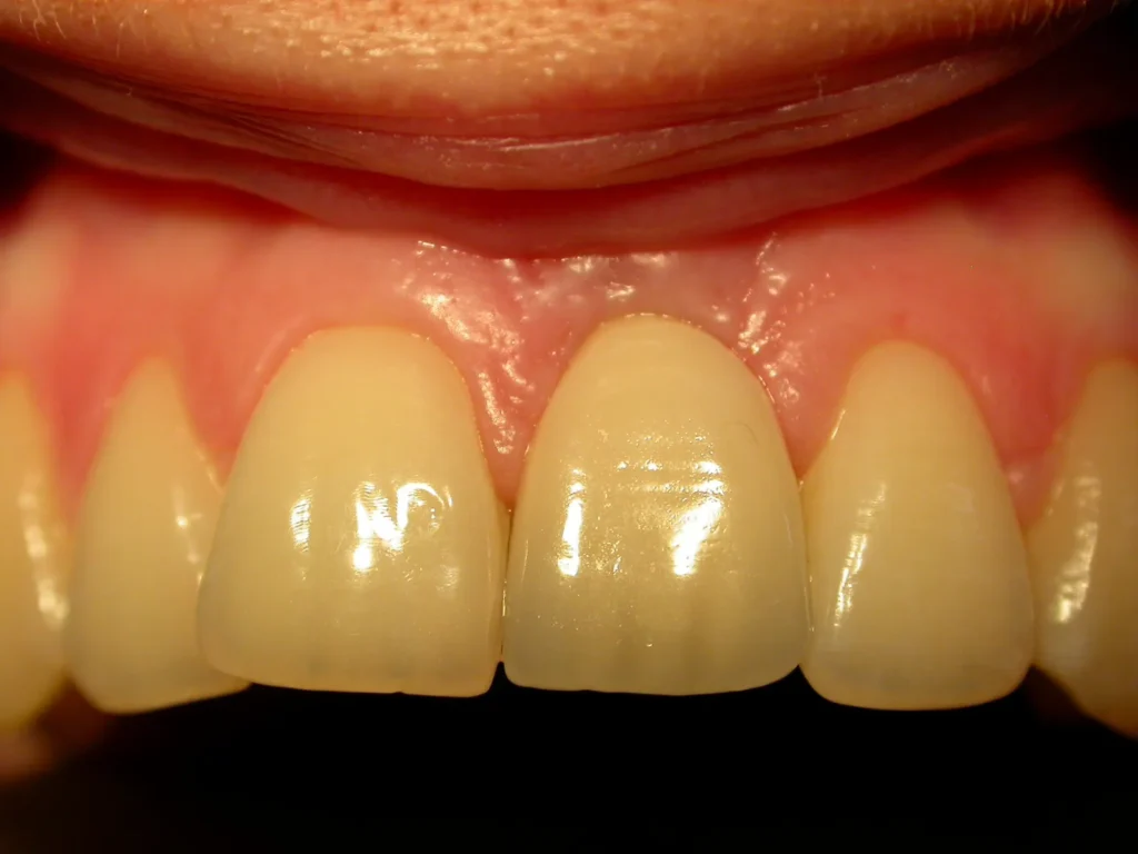 Ergebnis provisorische Implantat-Sofortversorgung: Dr. Peter, Arnstorf
