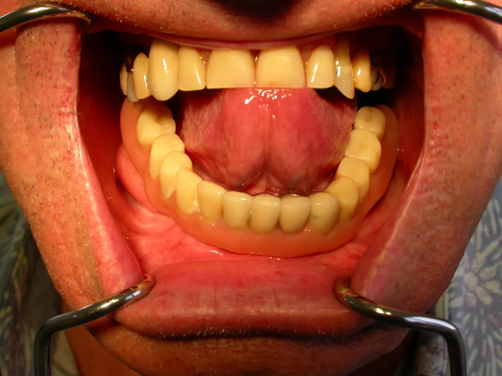 Auf Miniimplantaten festsitzende Prothese - Dr. Peter, 94424 Arnstorf