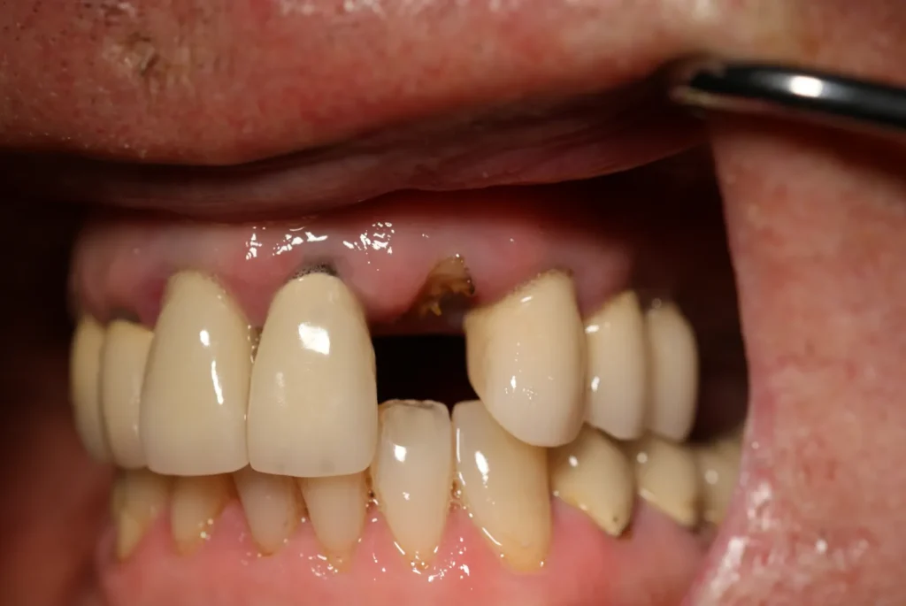 Wurzelrest 22 vor Implantat-Behandlung bei Dr. Peter, 94424 Arnstorf