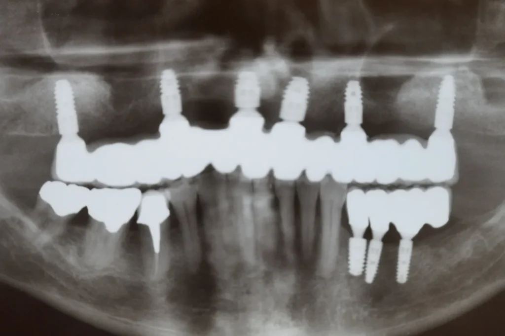Röntgenkontrolle nach Implantate-OP mit Sinuslift & Zahnersatz: Dr. Peter, Arnstorf